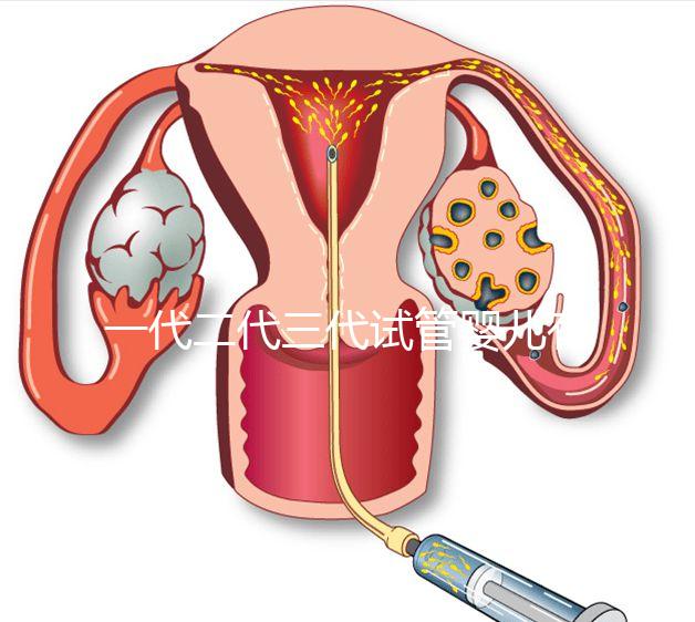 一代二代三代試管嬰兒有什么區(qū)別？