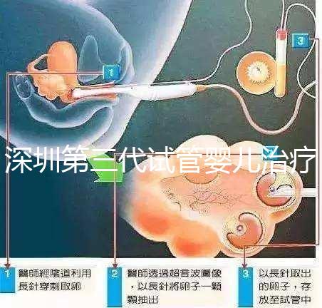 深圳第三代試管嬰兒治療大概需要多少錢?詳細費用清單助您了解預算