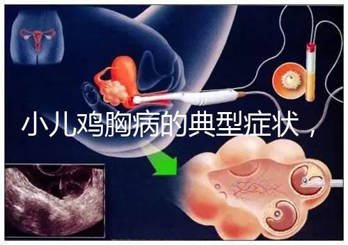 小兒雞胸病的典型癥狀，早發現早治療很重要！