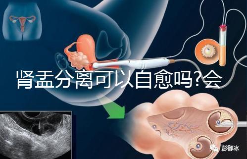 腎盂分離可以自愈嗎?會不會自己好要看造成的病因