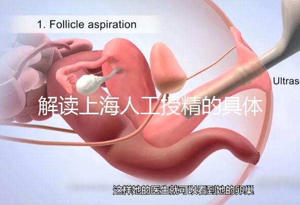 解讀上海人工授精的具體過程，會不會痛看醫生怎么說？